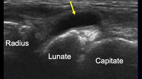 Arthrocentesis of the Wrist Joint - Internet Book Of MSK Ultrasound