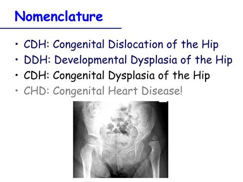 PPT CDH Congenital Dislocation Of The Hip PowerPoint Presentation