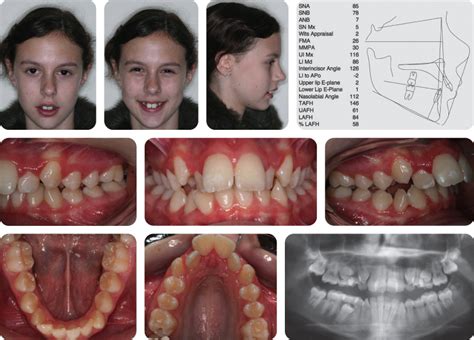 4 Class Ii Division 1 Malocclusion Pocket Dentistry