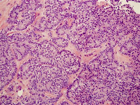 Pathology Outlines Well Differentiated Neuroendocrine Tumor