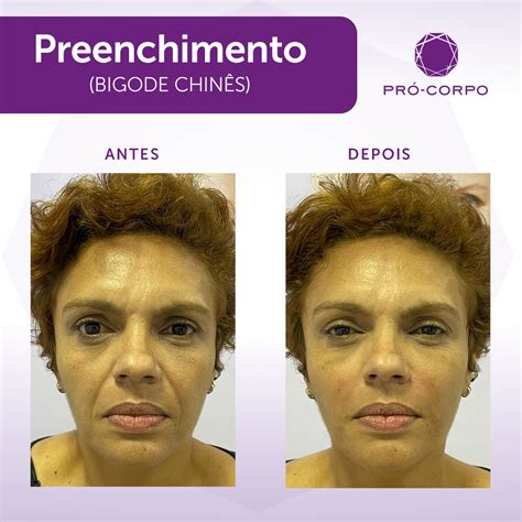 Preenchimento Labial Olheiras And Bigode Chinês Pró Corpo