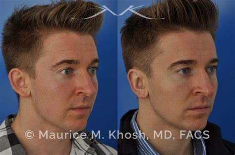 New York Ear Pinning Otoplasty Maurice M Khosh Md Facs