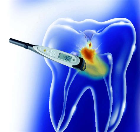 Diagnodent Cavity Detection Dentist In Arlington Wa