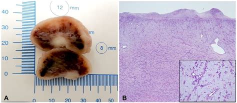 Resected infundibular myxoma (A) Section of myxoma biopsy (B)... | Download Scientific Diagram