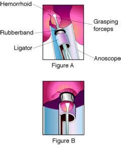 The Green Sanctuary: Haemorrhoid Surgery by Rubber Band Ligation