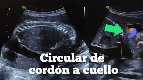 ECOGRAFÍA DE CIRCULAR DE CORDÓN A CUELLO YouTube