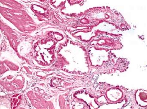 The Association Of Intestinal Metaplasia With The Cancerous Epithelium