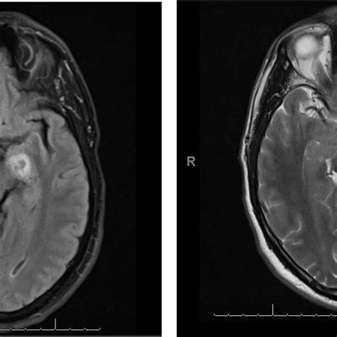 Axial Diffusion Weighted Mri Shows Restricted Diffusion In The