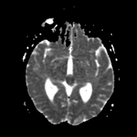 Pineal Parenchymal Tumor Of Intermediate Differentiation Image