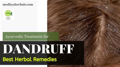 Ayurvedic Treatment For Dandruff 8 Best Remedies For Permanent Relief