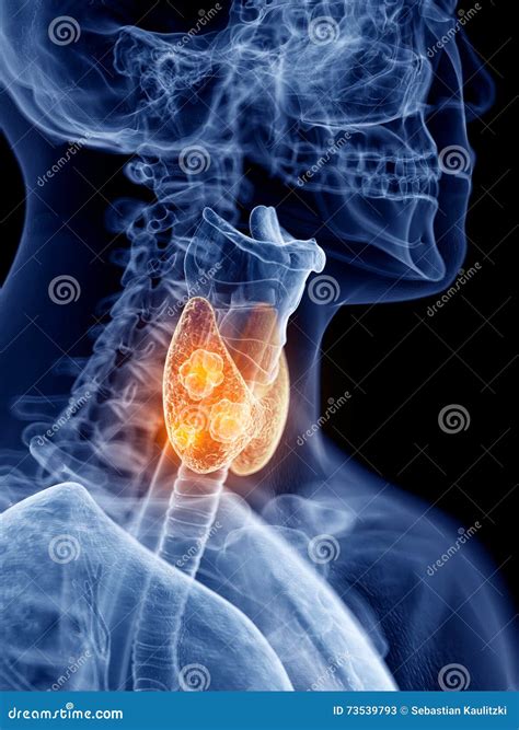 Thyroid cancer stock illustration. Illustration of accurate - 73539793