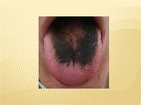 Diseases of tongue