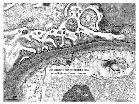 Electron Microscopy Showed Fine Granular Powdery Electron Dense