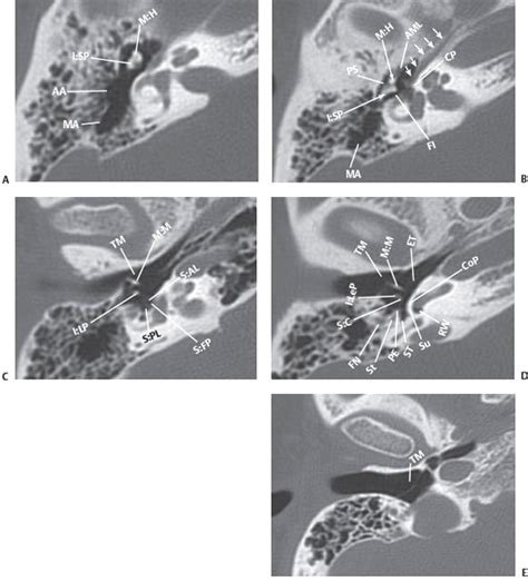 Mastoid Air Cells Anatomy