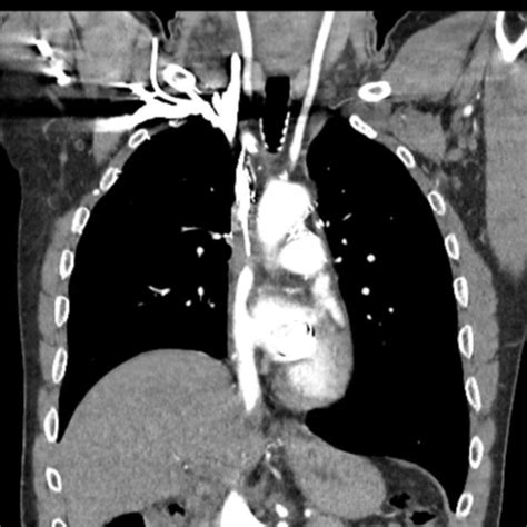 Vanishing Bone Metastases In Superior Vena Cava Obstruction Journal