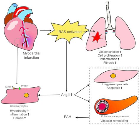 Pulmonary Arterial Hypertension Pathophysiology