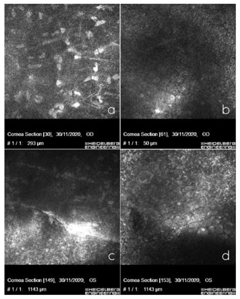 Ijms Free Full Text Posterior Polymorphous Corneal Dystrophy In A