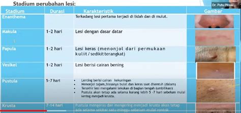 Cara Penularan Cacar Monyet Ciuman Seks Dan Jarum Gaya Hidup