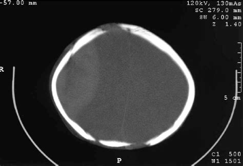 Ct Head Showing Extradural Haematoma With Overlying Skull Fracture