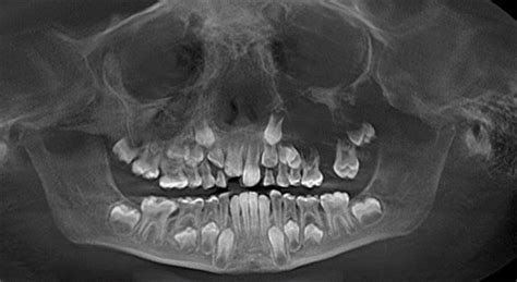 Fibrous Dysplasia Maxilla