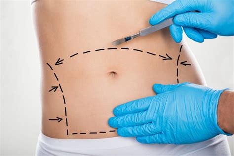 Abdominoplastia o que é como é feita quem pode fazer Descubra Dr