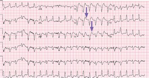 Atypical Presentation of Acute Myocardial Infarction | Consultant360