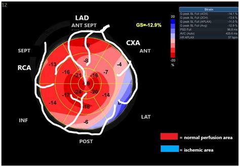 Diagnostics Free Full Text Myocardial Work Evaluationa Useful Non