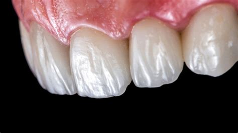 Veneers Roman Hochreiter Zahntechnisches Labor Wien