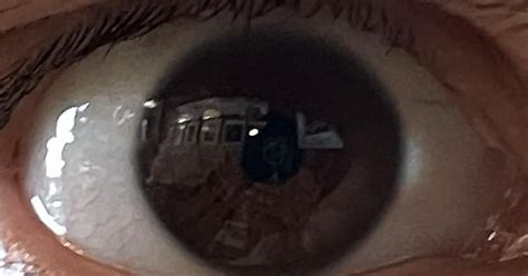 My Friends Eye Pooling Light In One Corner Album On Imgur