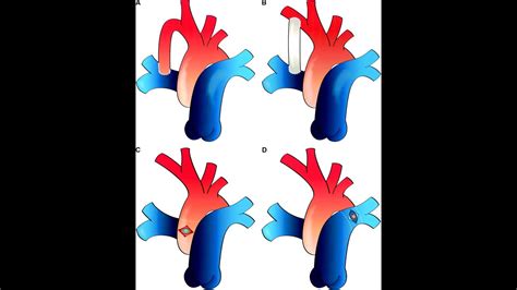 DU CPC 2022 23 Chirurgie des cardiopathies Congénitales Margaux