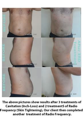 ultrasonic liposuction before and after - Pregnancy Depression