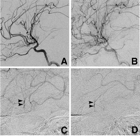 Left Internal Carotid Angiograms Lateral View After Initial Surgery