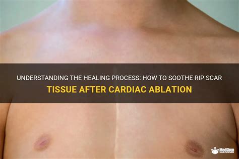 Understanding The Healing Process How To Soothe Rip Scar Tissue After Cardiac Ablation Medshun