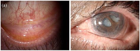 Bulbar Conjunctival Hyperemia