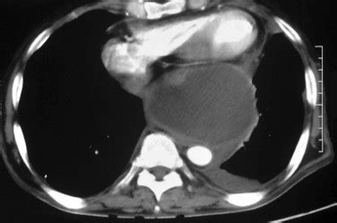 Clinical Presentation Radiological Features And Endoscopic Management