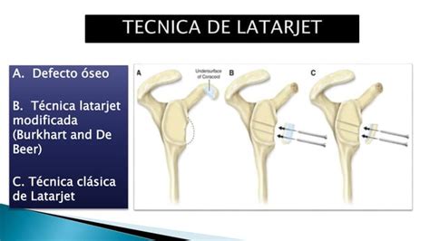 Tecnica De Latarjet Inestabilidad De Hombro Luxaci N De Hombro Ppt