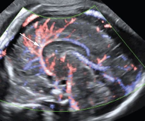 How To Image The Fetal Corpus Callosum Youssef 2013 Ultrasound In