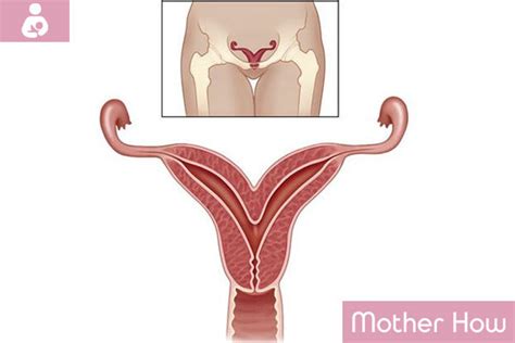 Bicornuate Uterus Causes Symptoms Treatment Motherhow