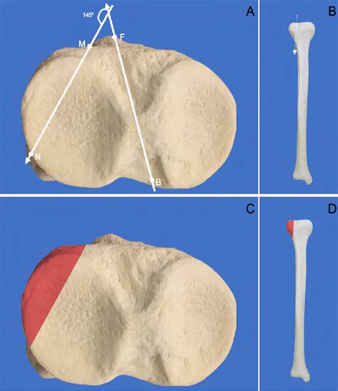 A Axial View Of The Right Tibial Plateau A Fracture Line Angle Of Download Scientific Diagram