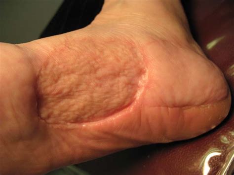 Malignant Melanoma Foot