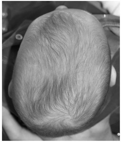 Anterior Plagiocephaly