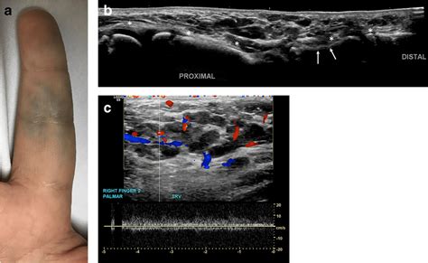 Vascular Malformation Venous Type Involving The Index Finger In A