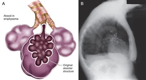 Medical Terms Сlinical Сases Emphysema