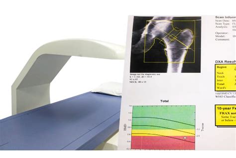 Ostéodensitométrie définition causes et traitements Elsan