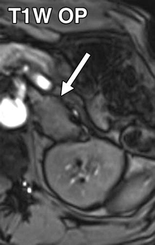 Characterization Of Genitourinary Lesions With Diffusion Weighted