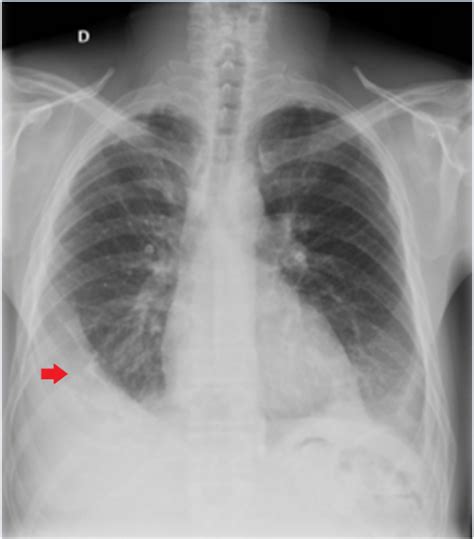 Hemodynamic Features Of Chronic Constrictive Pericarditis And