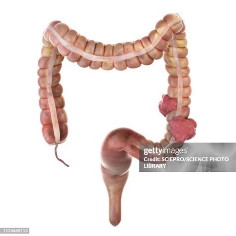 Colon Cancer Science Photos And Premium High Res Pictures Getty Images