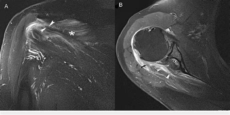 A 23 Year Old Man Presented With Pain In The Right Shoulder After An