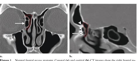 Figure From Failed Endoscopic Sinus Surgery Spectrum Of Ct Findings