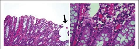 Figure 1 from Acute fulminant amoebic colitis: A Case report | Semantic ...